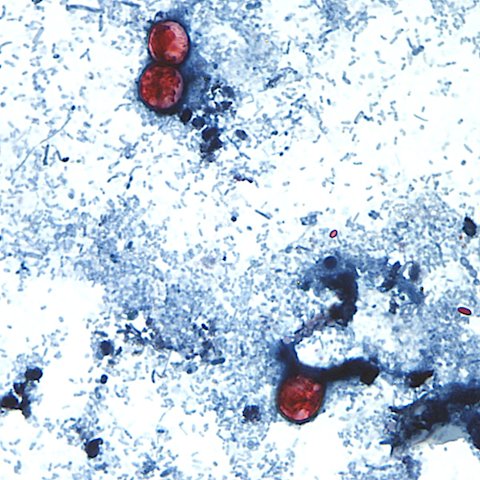 Video thumbnail for Parasite linked to contaminated produce spreads across U.S., doctor urges caution