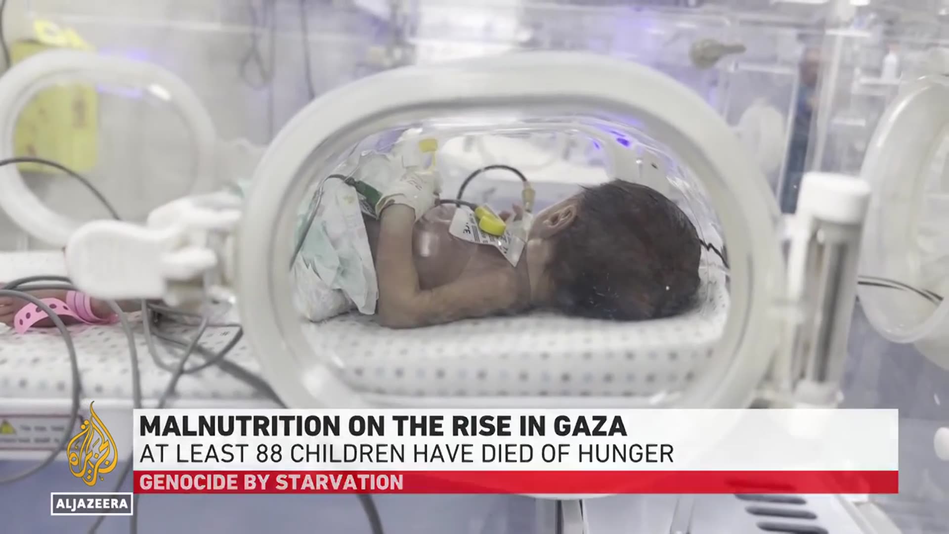'Video thumbnail for Babies in Gaza face irreversible harm from starvation and lack of aid, doctors warn'