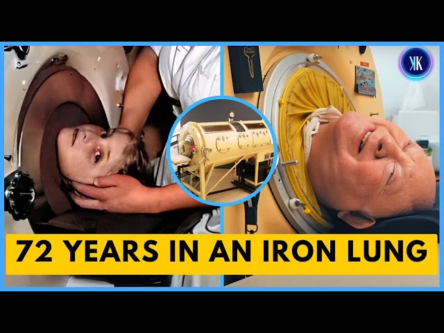 Video thumbnail for Man Lived His To The Fullest In An Iron Lung
