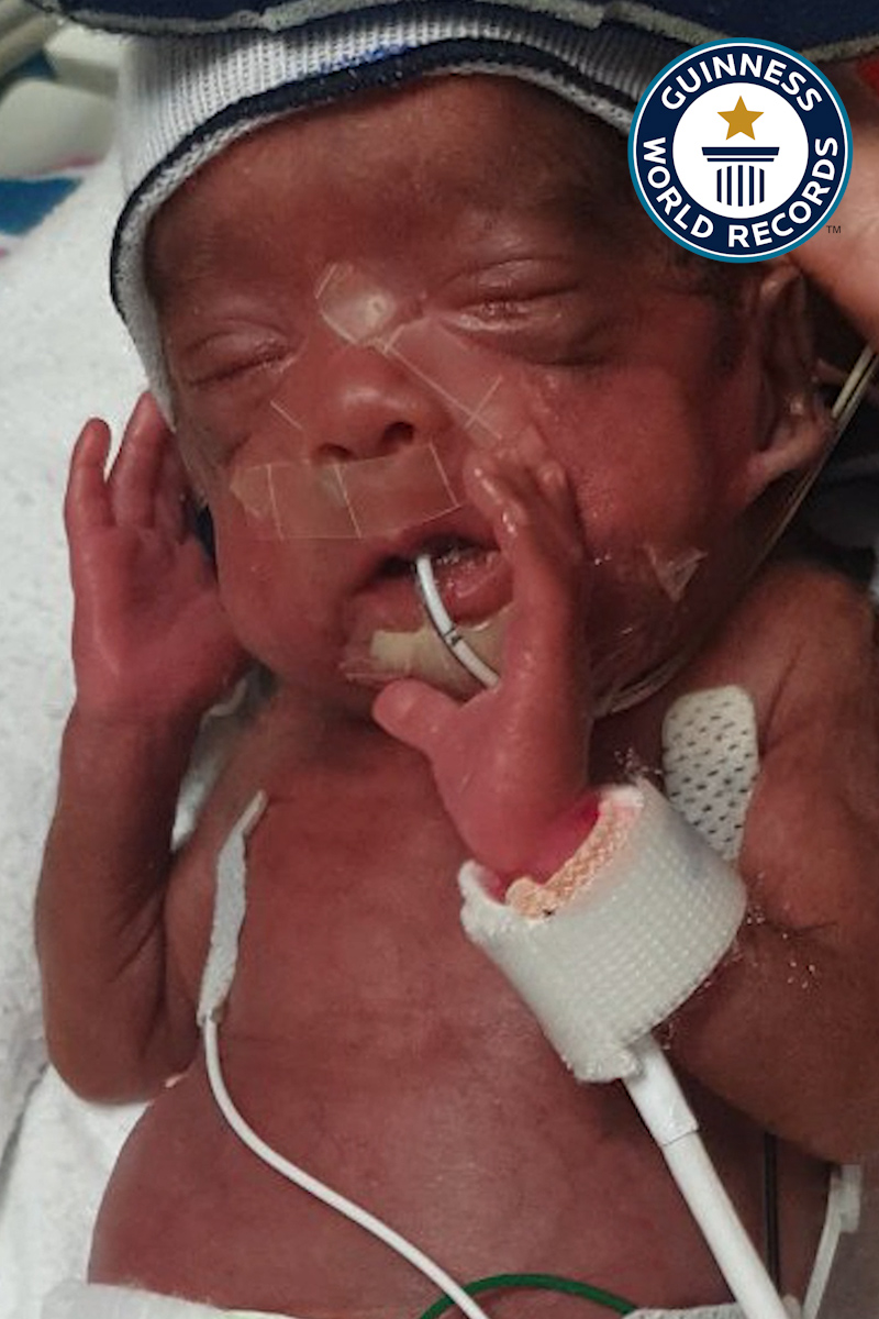 'Video thumbnail for Miracle twins defy odds with record-breaking premature birth'