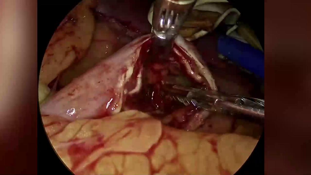 Video thumbnail for India: Warning: Graphic Content: Doctors remove 14 pens, 5 spoons, candle from woman’s stomach in shocking surgery.