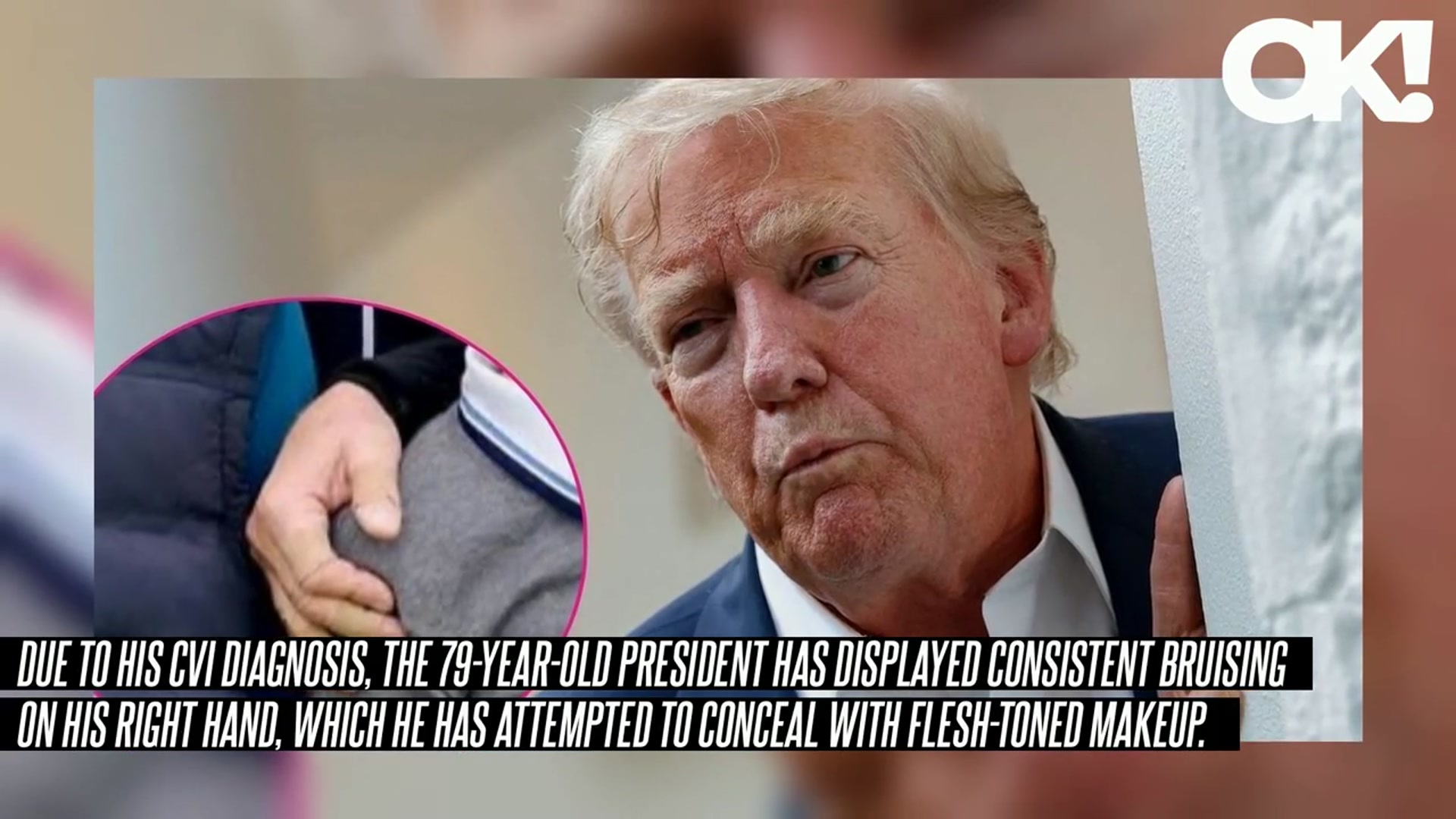 'Video thumbnail for Donald Trump Sparks Health Concerns as He's Seen Wearing 4 Band-Aids on Bruised Hand During Golf Outing in Scotland'