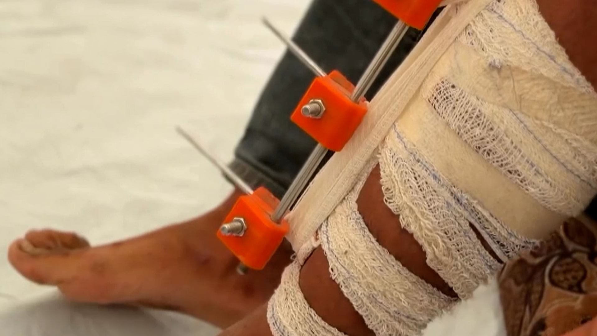 Video thumbnail for Gaza doctors create 3D-printed devices to save patients from amputation