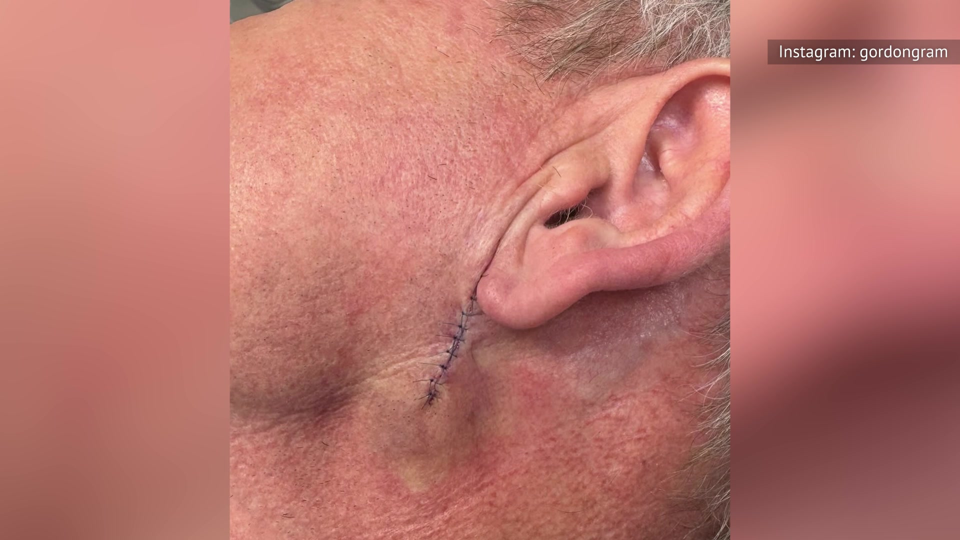 'Video thumbnail for Gordon Ramsay's Health Issues, Explained'