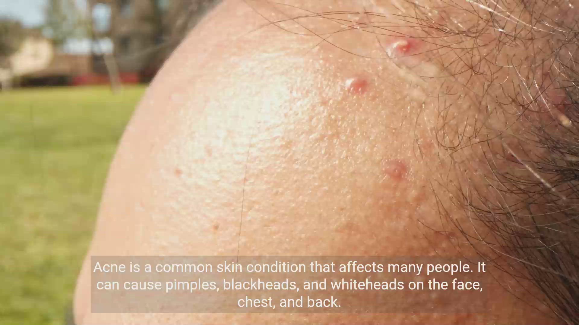 'Video thumbnail for Clear Skin Secrets: Effective Acne Treatment'