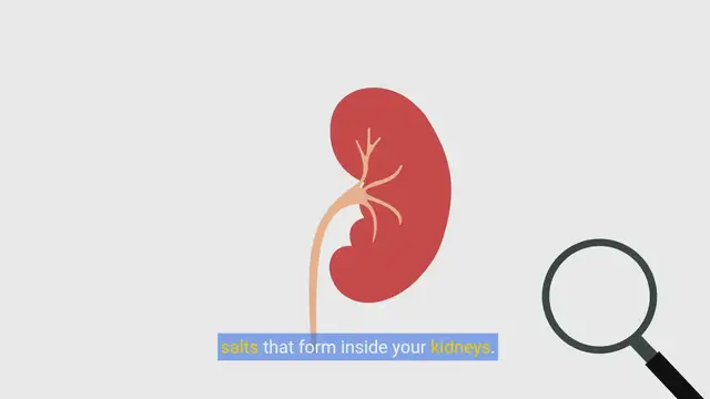 Video thumbnail for Understanding Kidney Stones: Symptoms, Causes, and Prevention