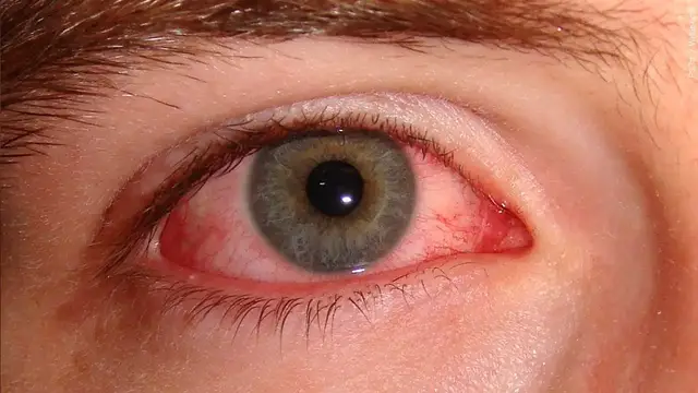 Video thumbnail for COVID 19 and Pink Eye