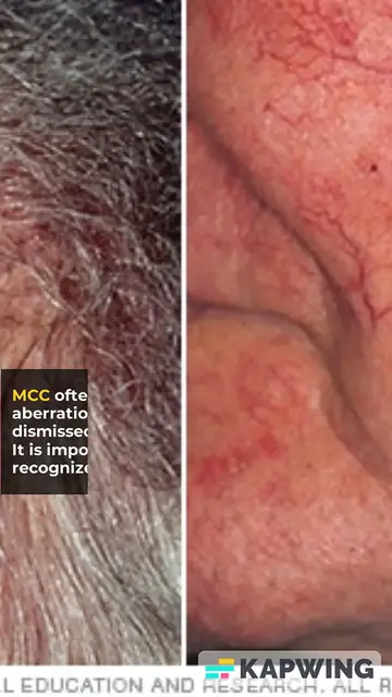 'Video thumbnail for Merkel Cell Carcinoma: Symptoms, Causes, and Early Detection'