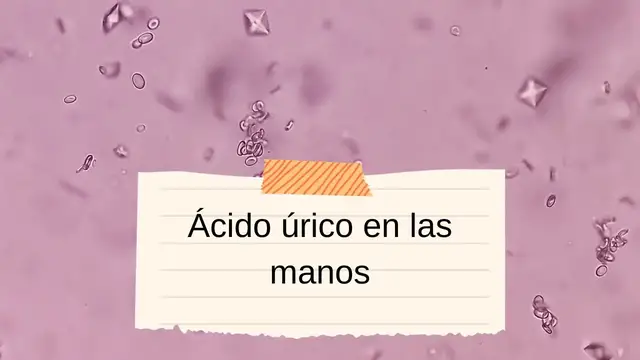 Video thumbnail for Ácido úrico en las manos: video blog