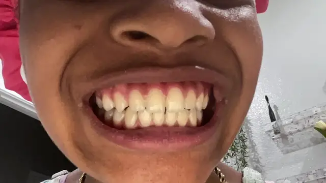 'Video thumbnail for White teeth hack works?'