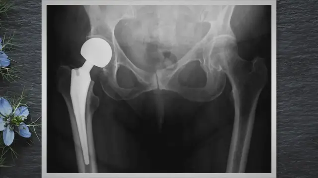 'Video thumbnail for Prothèse de hanche : Que faire après la chirurgie ?'