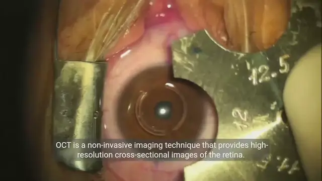 Video thumbnail for The Role of Optical Coherence Tomography (OCT)