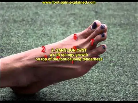 'Video thumbnail for midtarsal fault'