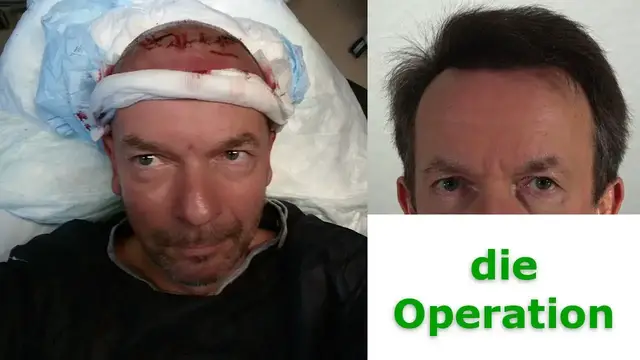 'Video thumbnail for Teil 2: Ablauf einer Haartransplantation in Istanbul - Die Operation'