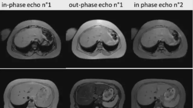 Video thumbnail for Non-alcoholic Fatty Liver Disease (NAFLD)
