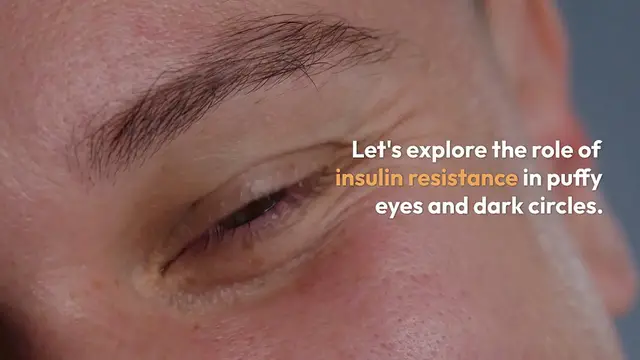 Video thumbnail for Combat_Puffy_Eyes_Naturally