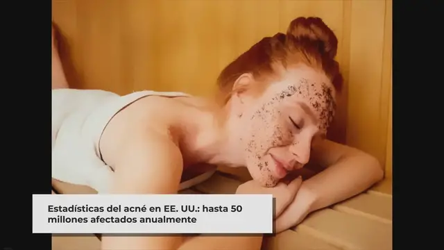 Video thumbnail for ▷ ¿Puede la sauna deshacerse del acné?