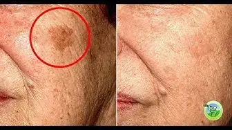 'Video thumbnail for 5 Home Remedies to Remove Any Type of Skin Spot from Your Face'