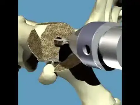 'Video thumbnail for Bunion correction by total joint implant #education #doctor #motivation'