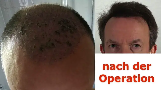 'Video thumbnail for Teil 3: Ablauf einer Haartransplantation in Istanbul - Nach der Operation'