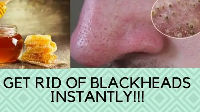 'Video thumbnail for How To Get Rid Of Blackheads Naturally Overnight -Get rid of blackheads and clogged pores overnight'