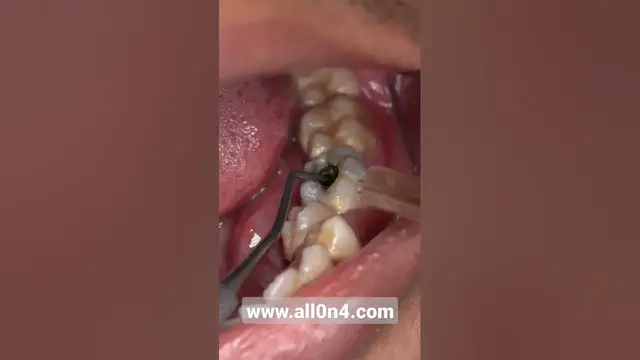 Video thumbnail for #dental #cleaning #shorts ??#braces #veneers  #scaling #doktergigi #dentist #satisfyingvideos