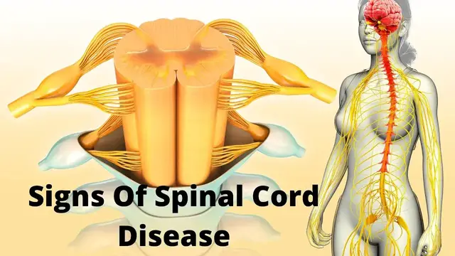 Video thumbnail for 10 Signs you may have a spinal cord disease