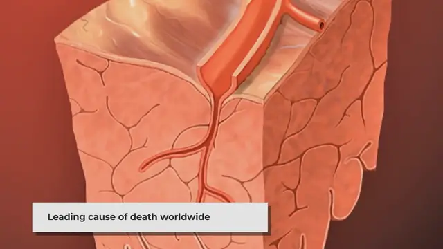Video thumbnail for Coronary Artery Disease: Understanding Risks and Prevention