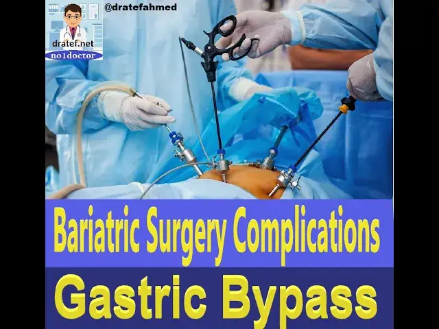 Video thumbnail for Bariatric Surgery Complications/Gastric Bypass Complications/Sleeve Gastrectomy/Weight loss surgery