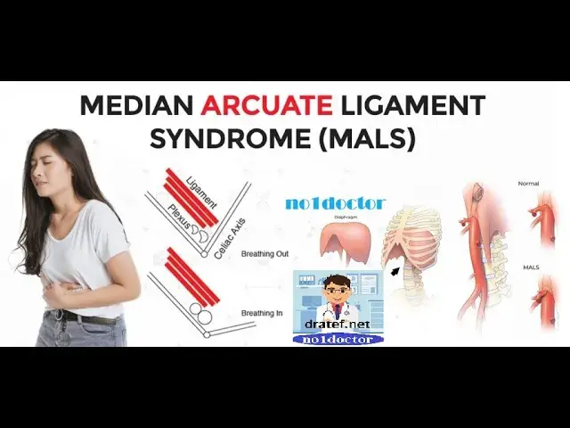 Video thumbnail for Median Arcuate Ligament Syndrome: A Rare Cause of Abdominal Pain   #no1doctor #syndrome #medical