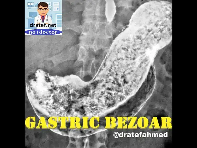 Video thumbnail for Gastric Bezoar /Causes/Symptoms and signs /Diagnosis /Bezoar Removal/ Endoscopic /Surgical/No1doctor