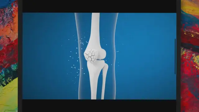 'Video thumbnail for Vitamin D Deficiency – Causes, Symptoms, And Treatment'