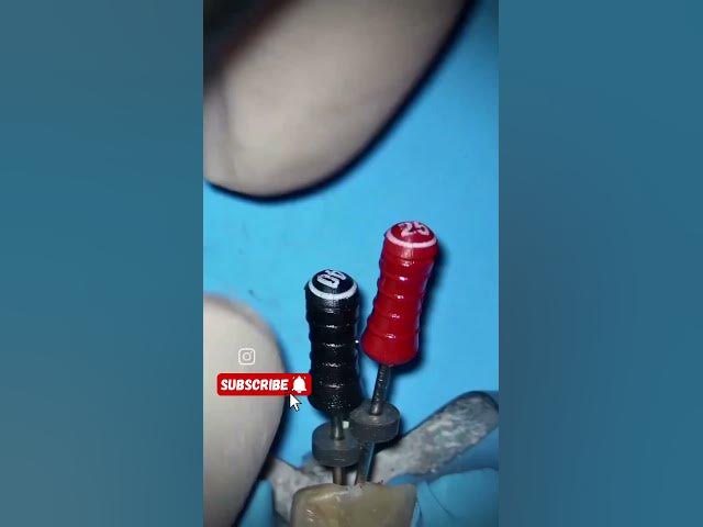 Video thumbnail for Dirty Gutta percha removal