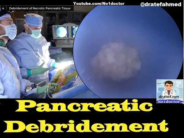 Video thumbnail for Pancreatic Debridement/Necrosectomy/Robotic Open Lap Endoscopic Debridement/Medical Lecture/Mrcs