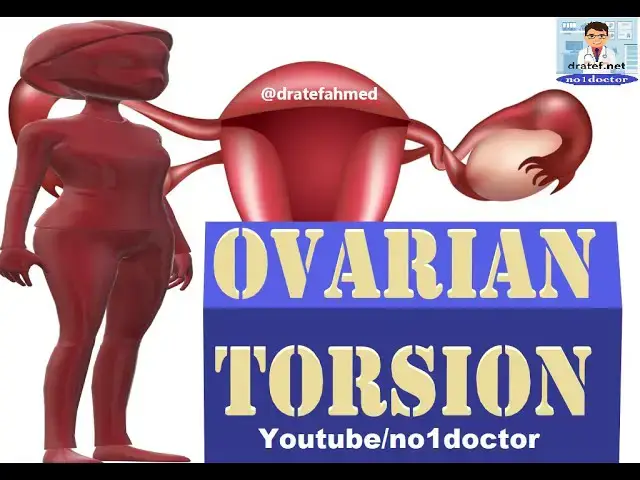 Video thumbnail for Ovarian Torsion/Emergency ovarian torsion surgery/ovarian cyst removal /Usmle/ Mrcs/No1doctor/dratef