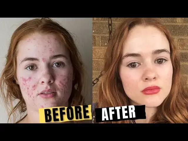 Video thumbnail for 17 ANTI ACNE Foods You Must Eat To Get Rid Of Acne  Scars
