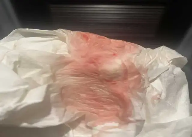 Video thumbnail for Heavy implantation bleeding stories: Is it always of concern?