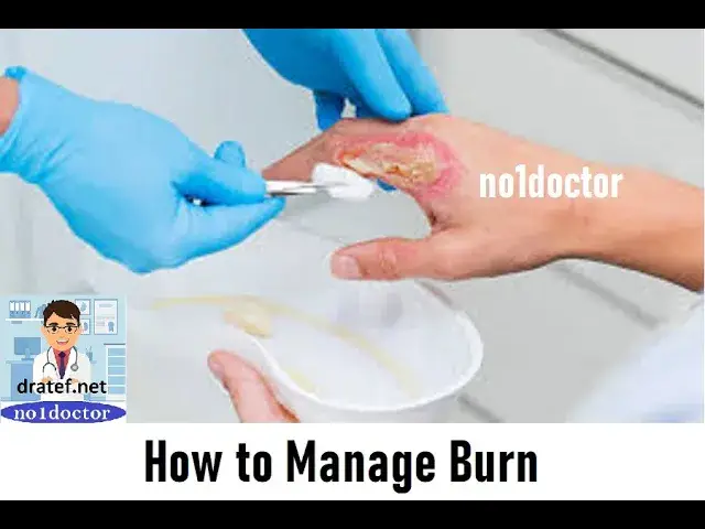 Video thumbnail for How to Manage Burn  / Burn Managment / 1ist aids Measures In Burn Injury /Burn Injury / No1doctor