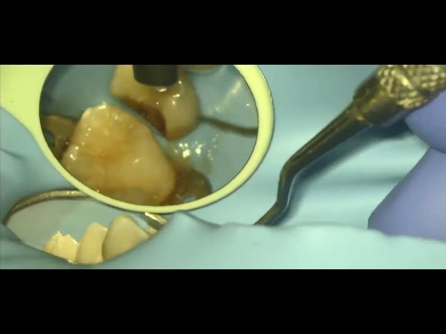 Video thumbnail for Rubber Dam Cheat Sheet: Master Deep Margins in 1 Minute