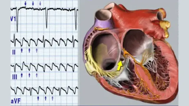 Video thumbnail for Atrial Flutter Causes, Symptoms, Treatment, and Management Strategies