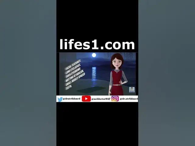 Video thumbnail for Cornelia De Lange Syndrome #medicalsyndrome #syndromes #shorts  #Mrcs  #Frcs #Usmle  #MedicalStudent