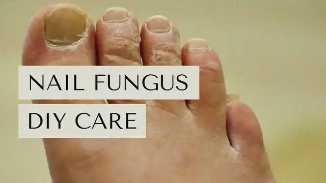Video thumbnail for Nail Fungus DIY Care