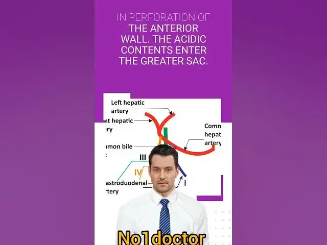 Video thumbnail for artery of duodenal hemorrhage #shorts #anatomy #gastroduodenal #artery #peptic_ulcer #hemmorrhage