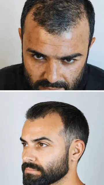 Video thumbnail for Haartransplantation in Mannheim: Moderne Lösungen für Haarausfall