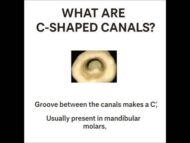Video thumbnail for C-Shaped Canal in Endodontics Explained | Dentistry Simplified Ep.1