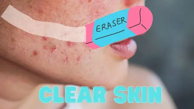 'Video thumbnail for 10 ways to erase pimple'