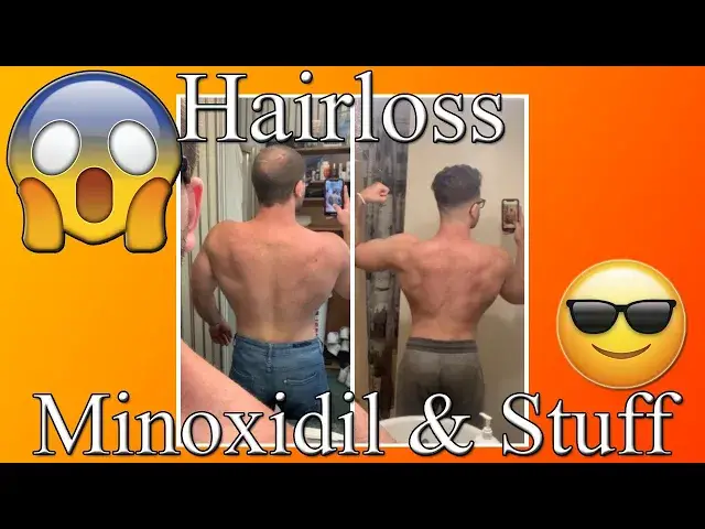 Video thumbnail for Riffin' On Hair Loss (Minoxidil: Does it REALLY work, what to expect, good practices, other stuff.)