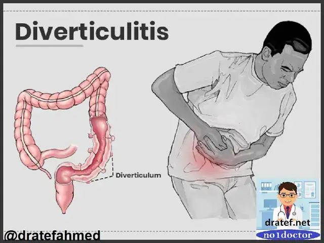 Video thumbnail for Diverticulitis/Symptoms/Signs /Diagnosis/Treatments /Pain left side abdomen/No1doctor / Lecture