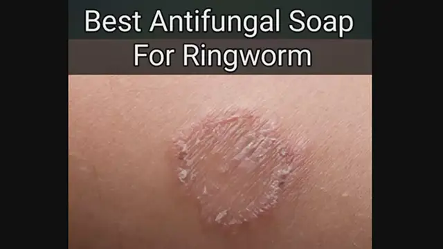 'Video thumbnail for Best Antifungal Soap For Ringworm'