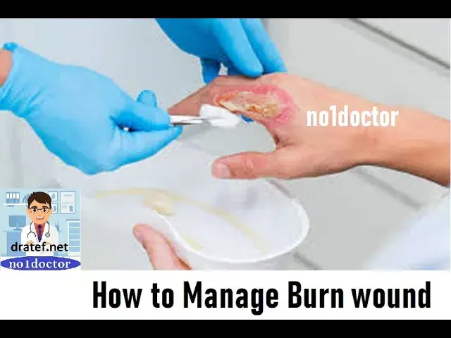 Video thumbnail for How to Manage Burn Wound  / Burn Wound  Managment / 1ist aids Measures In Burn Injury /Burn Injury